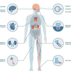 All statements regarding diabetes are true except which one